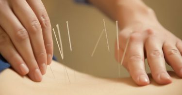 Acupuntura barata en Barcelona
